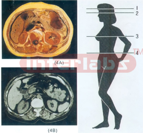 ANATOMICAL DISL MODEL OF FEMALE HUMAN TORSO Section 4